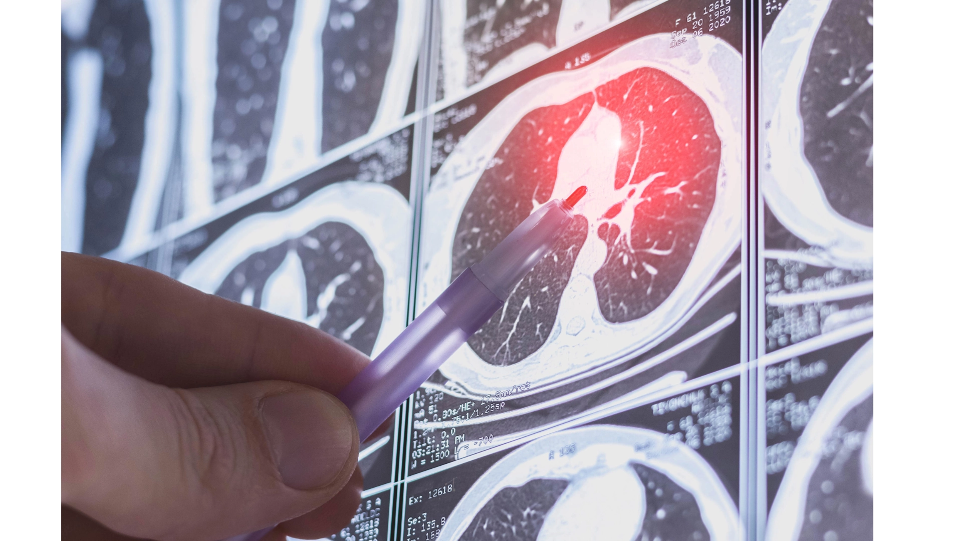 Các Nhà Khoa Học Tạo Ra Phổi In 3D Cứu Sống Hàng Triệu Bệnh Nhân